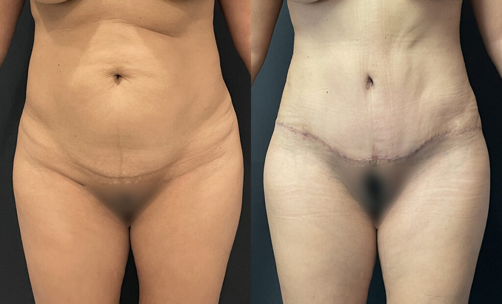 Hi-Def Liposuction Before and After Photo by Dr. Jacobson in Beverly Hills California