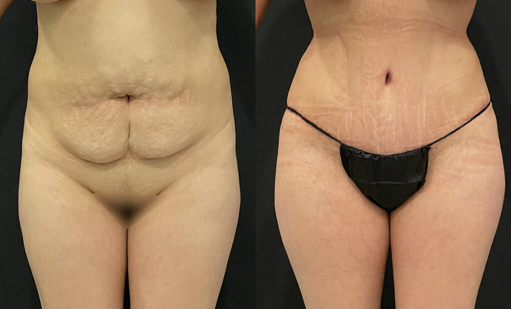 Hi-Def Liposuction Before and After Photo by Dr. Jacobson in Beverly Hills California
