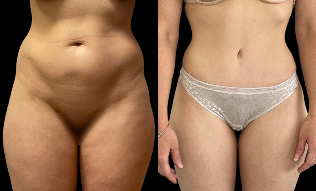 Hi-Def Liposuction Before and After Photo by Dr. Jacobson in Beverly Hills California