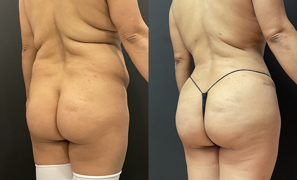 Brazilian Buttock Lift Before and After Photo by Dr. Jacobson in Beverly Hills California