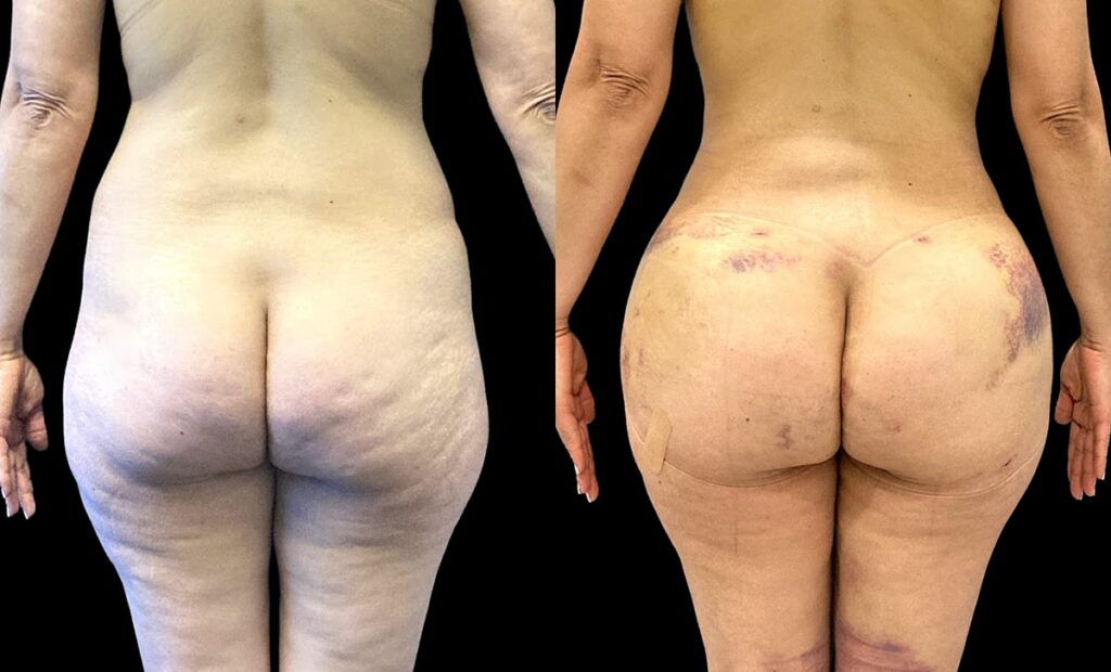 Brazilian Buttock Lift Before and After Photo by Dr. Jacobson in Beverly Hills California