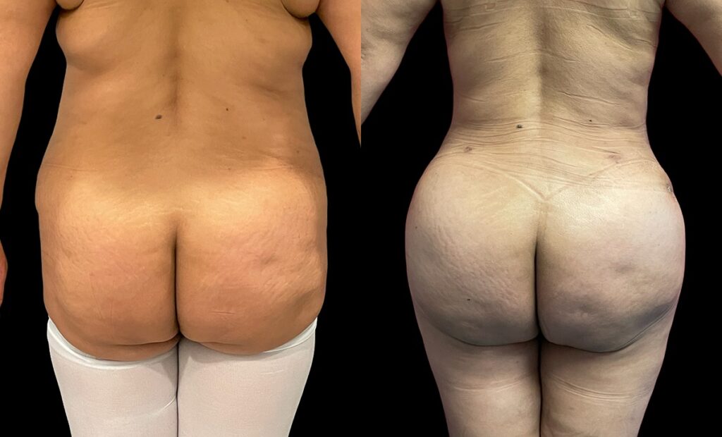 Brazilian Buttock Lift Before and After Photo by Dr. Jacobson in Beverly Hills California