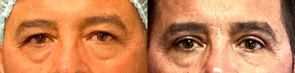 Blepharoplasty Before and After Photo by Dr. Jacobson in Beverly Hills California
