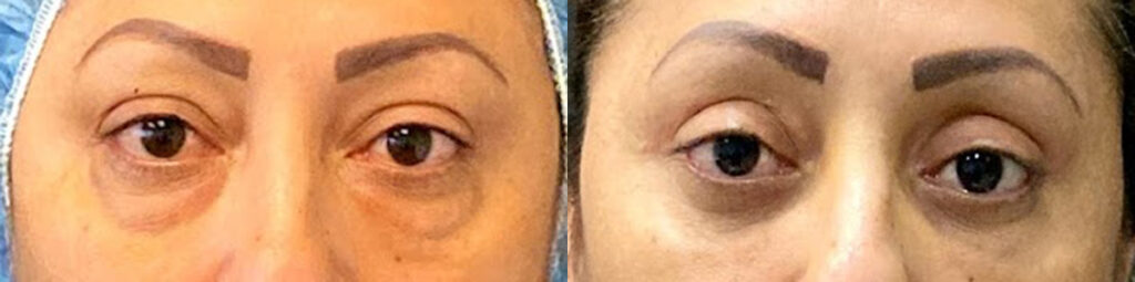 Blepharoplasty Before and After Photo by Dr. Jacobson in Beverly Hills California