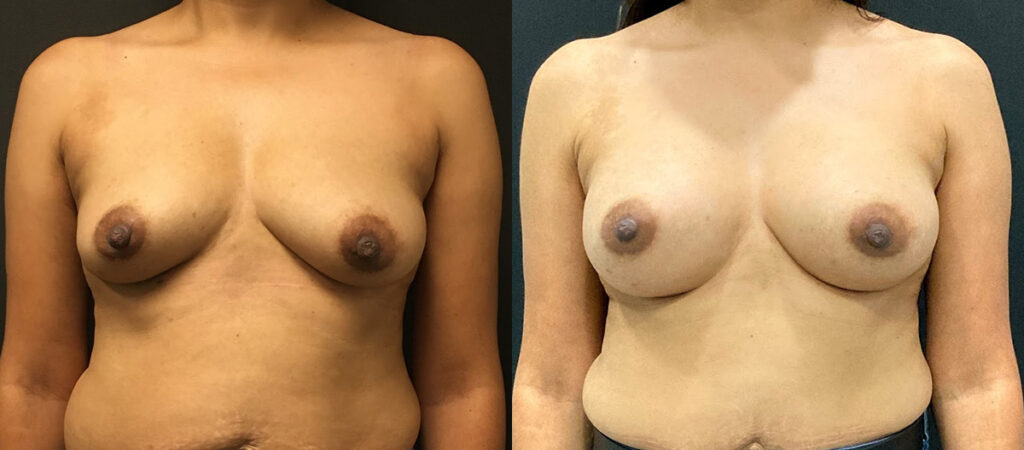 Breast Augmentation Before and After Photo by Dr. Jacobson in Beverly Hills California