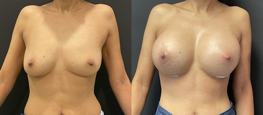 Breast Augmentation Before and After Photo by Dr. Jacobson in Beverly Hills California