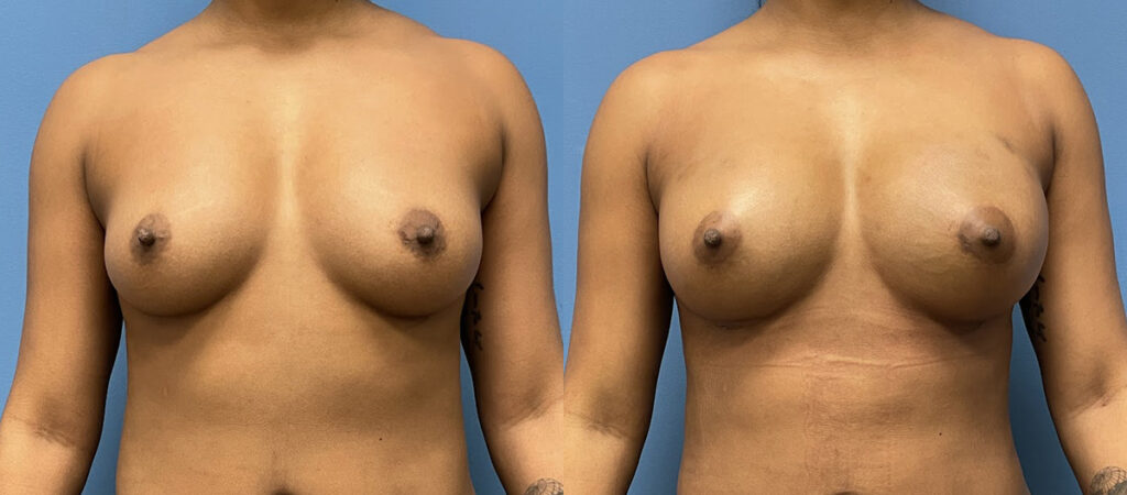 Breast Fat Grafting Before and After Photo by Dr. Jacobson in Beverly Hills California