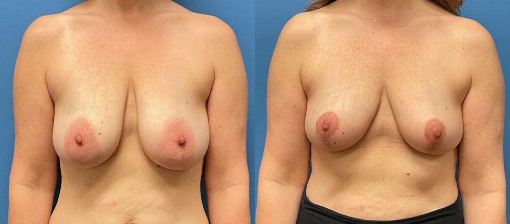 Breast Lift Before and After Photo by Dr. Jacobson in Beverly Hills California