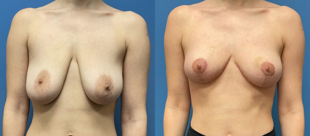 Breast Lift Before and After Photo by Dr. Jacobson in Beverly Hills California