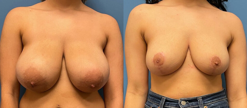 Breast Reduction Before and After Photo by Dr. Jacobson in Beverly Hills California