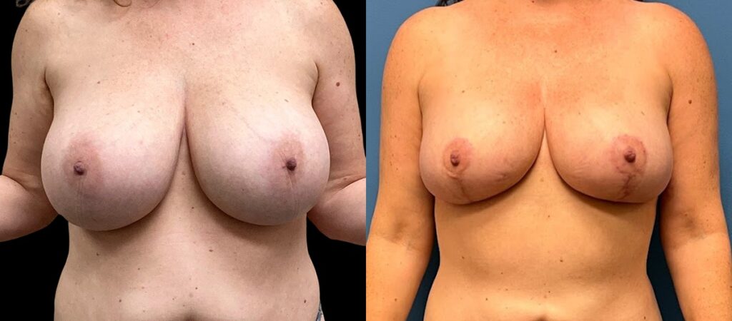 Breast Reduction Before and After Photo by Dr. Jacobson in Beverly Hills California