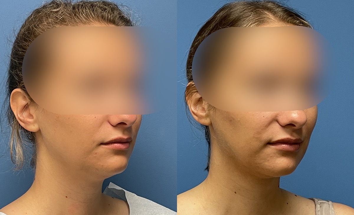 Chin Lipo Before and After Photo by Dr. Jacobson in Beverly Hills California