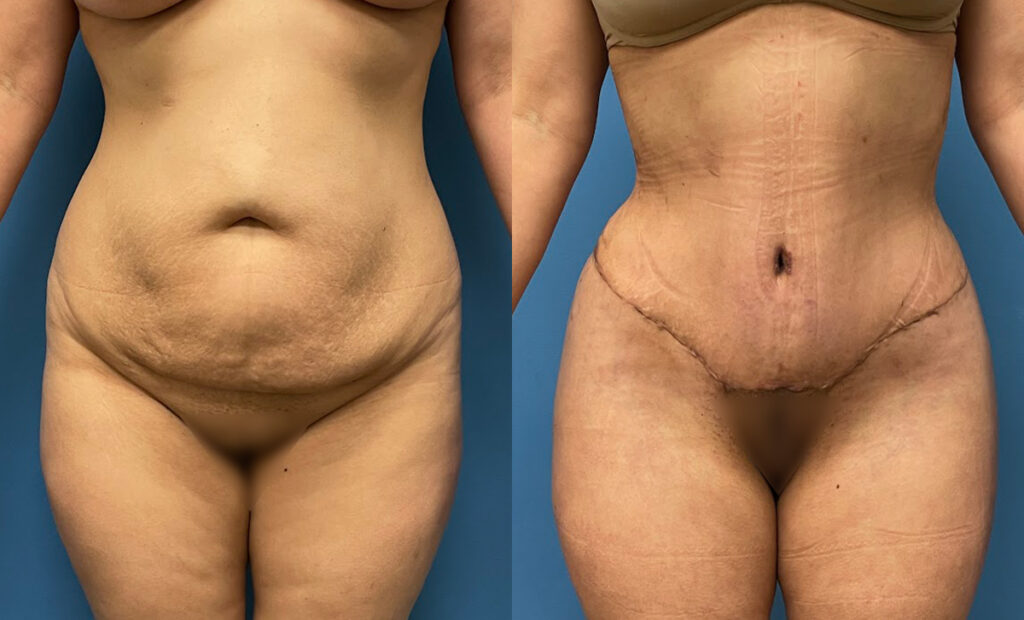 Abdominoplasty Before and After Photo by Dr. Jacobson in Beverly Hills California