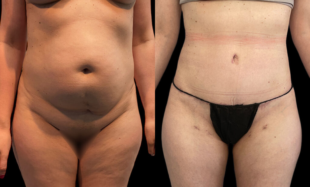 Abdominoplasty Before and After Photo by Dr. Jacobson in Beverly Hills California