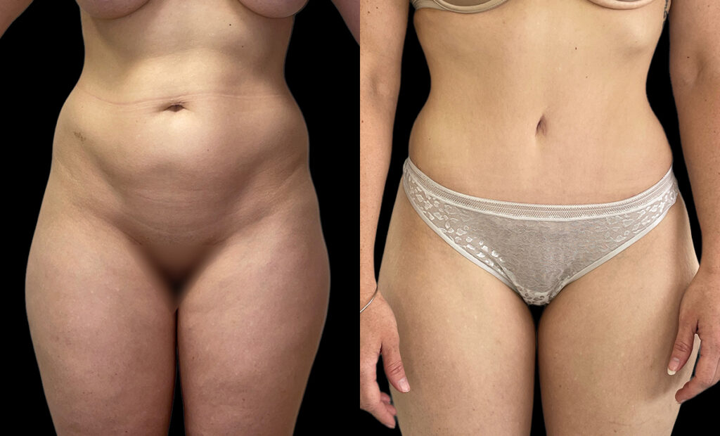 abdominoplasty of