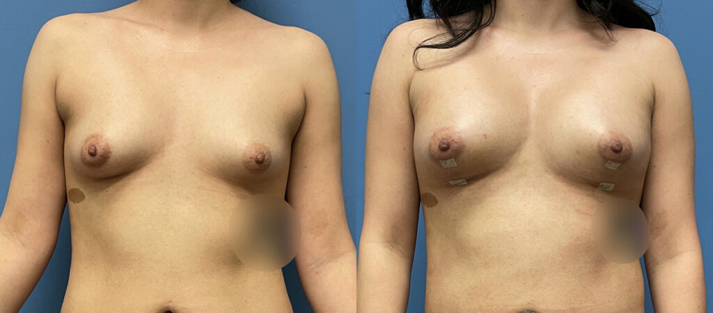 breast fat grafting Before and After Photo by Dr. Jacobson in Beverly Hills California