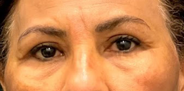 Blepharoplasty after photo by Dr. Jacobson in Beverly Hills, CA