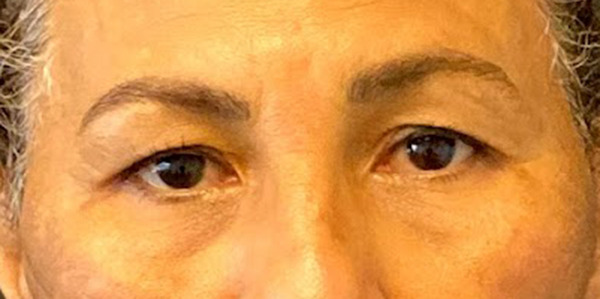 Blepharoplasty before photo by Dr. Jacobson in Beverly Hills, CA