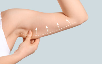 When Should You Consider an Arm Lift? Signs You Need to Look Out For