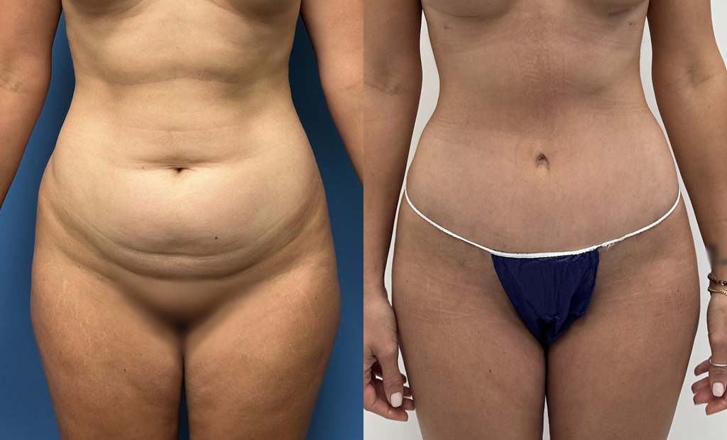 Tummy Tuck Before and After Photo by Jacobson Plastic Surgery in Beverly Hills CA