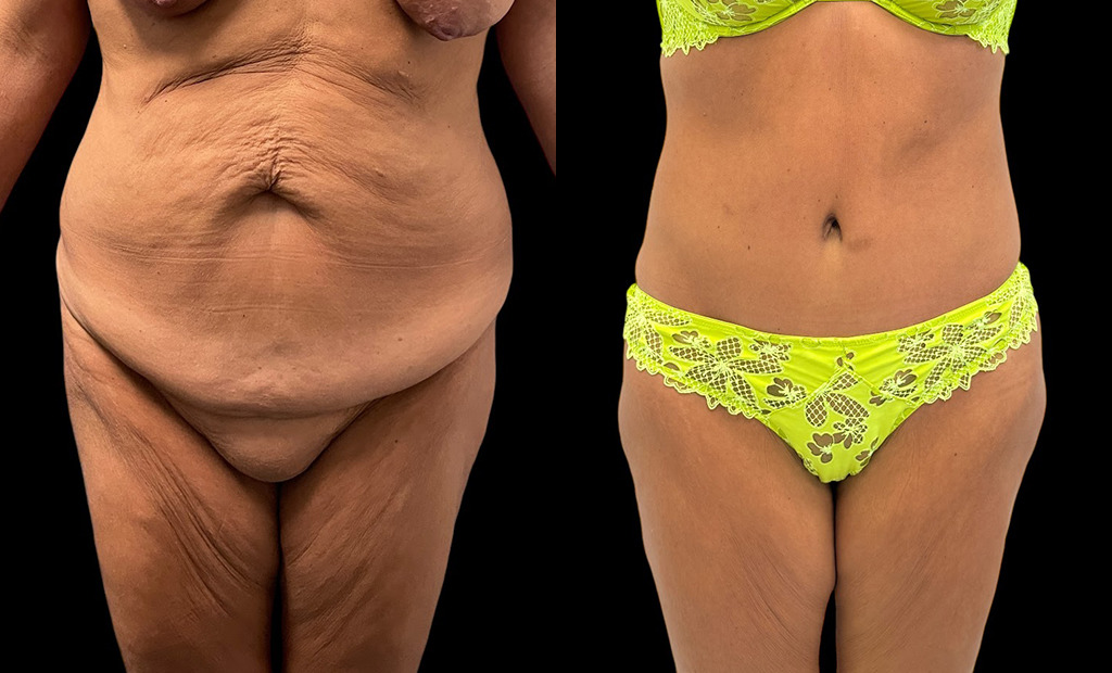 Tummy Tuck Before and After Photo by Jacobson Plastic Surgery in Beverly Hills CA