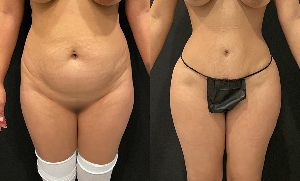 Tummy Tuck Before and After Photo by Jacobson Plastic Surgery in Beverly Hills CA