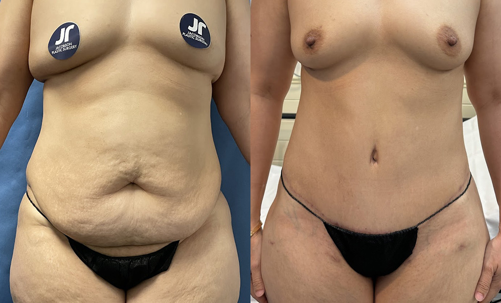 Tummy Tuck Before and After Photo by Jacobson Plastic Surgery in Beverly Hills CA