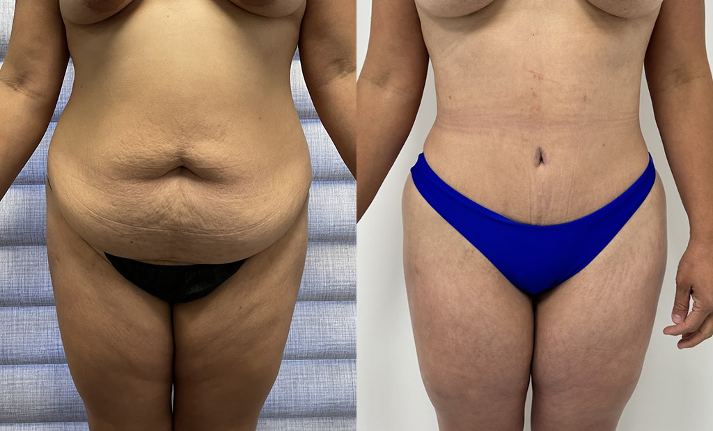Tummy Tuck Before and After Photo by Jacobson Plastic Surgery in Beverly Hills CA
