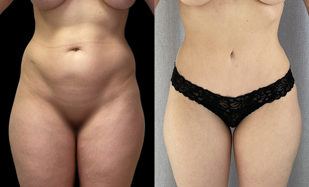 Tummy Tuck Before and After Photo by Jacobson Plastic Surgery in Beverly Hills CA