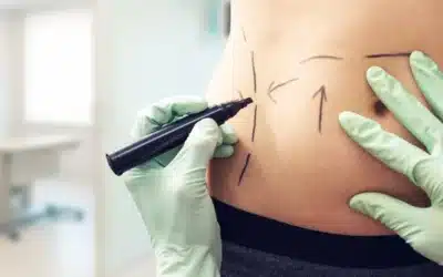 Finding the Best Tummy Tuck Doctor in Los Angeles: What to Look For